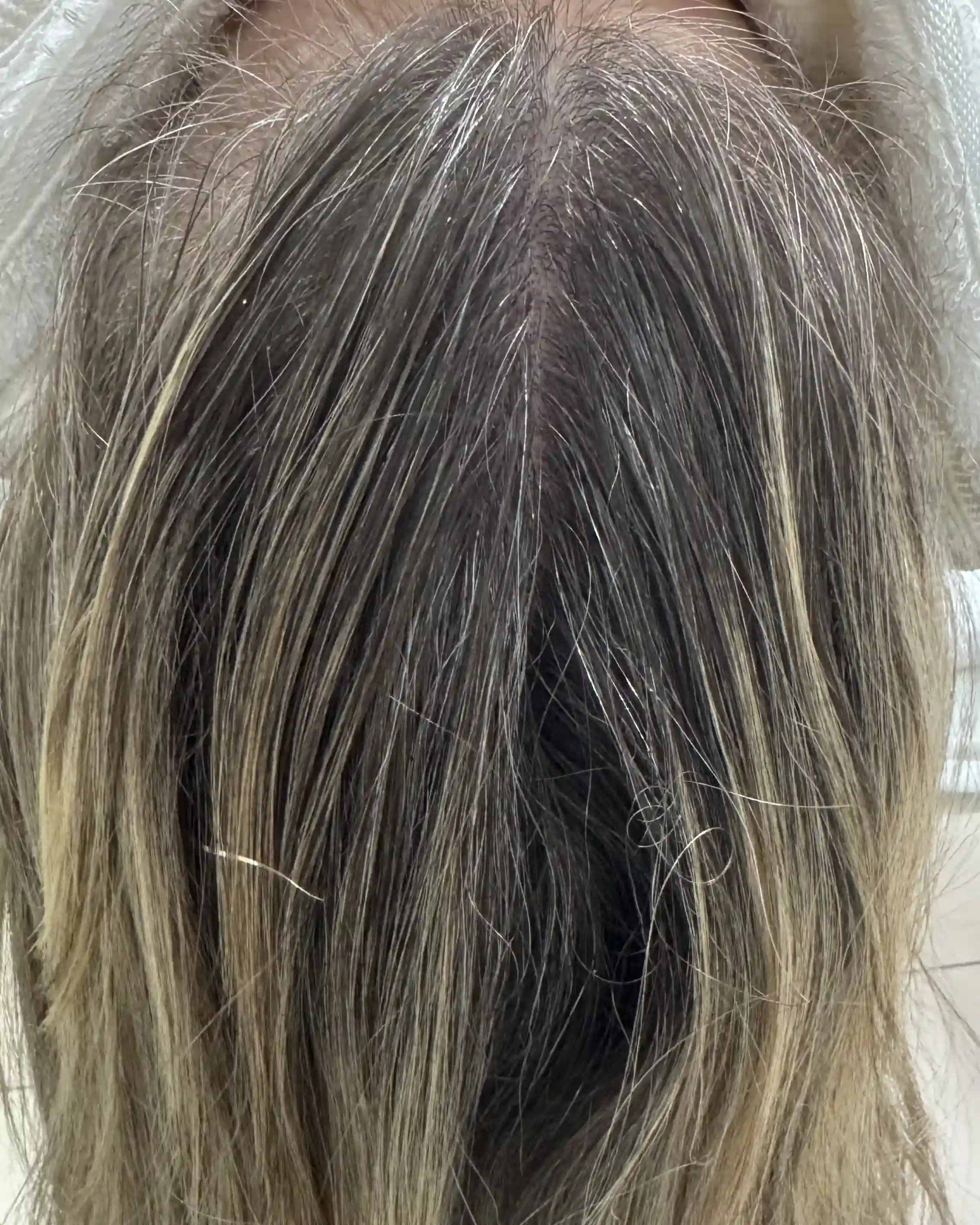 Antes e depois — tratamento de queda capilar em 5 Sessões — Rapha Beauty Tatuapé (Antes)