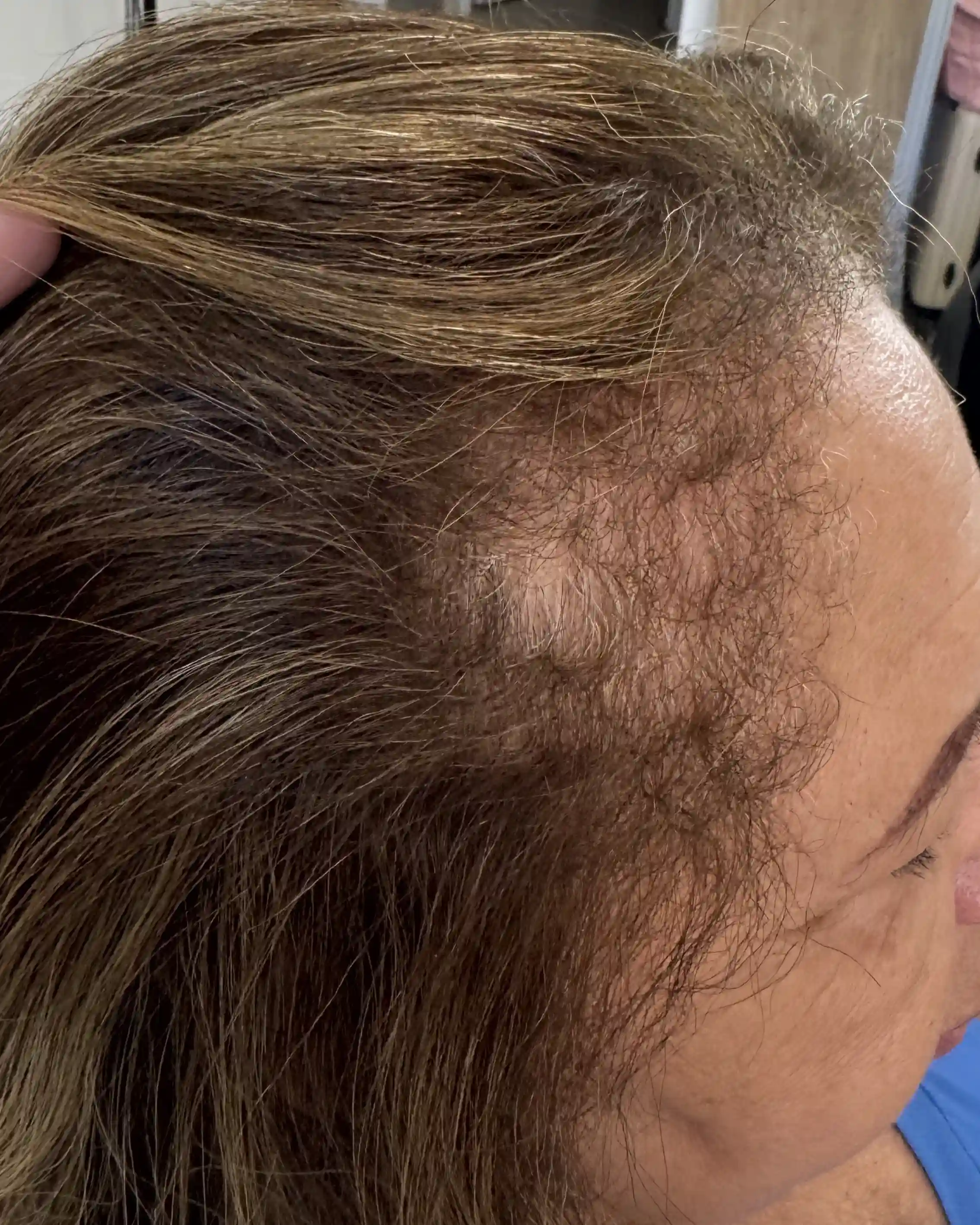 Antes e depois — tratamento de eflúvio telógeno em 9 Sessões — Rapha Beauty Tatuapé (Antes)
