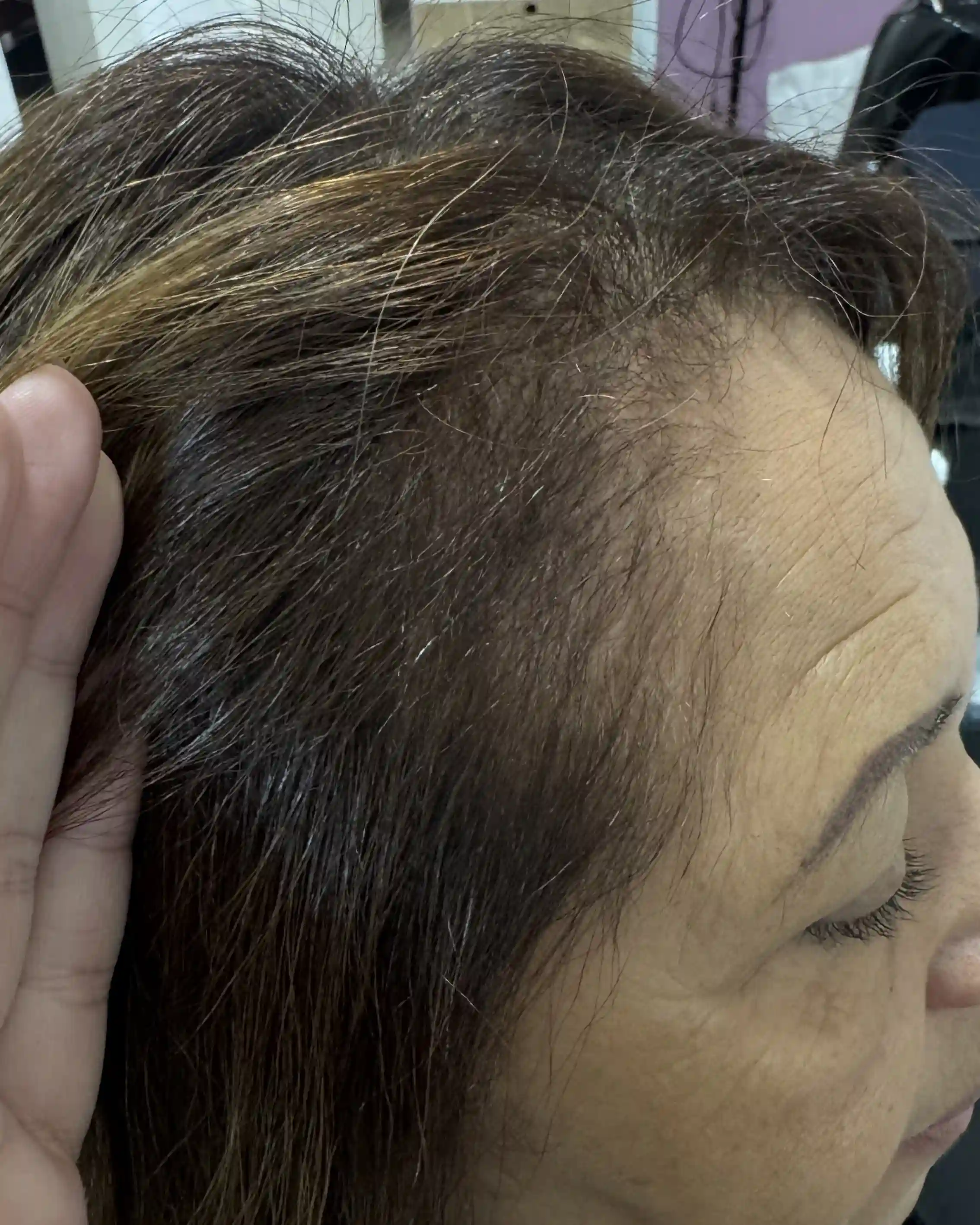 Antes e depois — tratamento de eflúvio telógeno em 9 Sessões — Rapha Beauty Tatuapé (Depois)