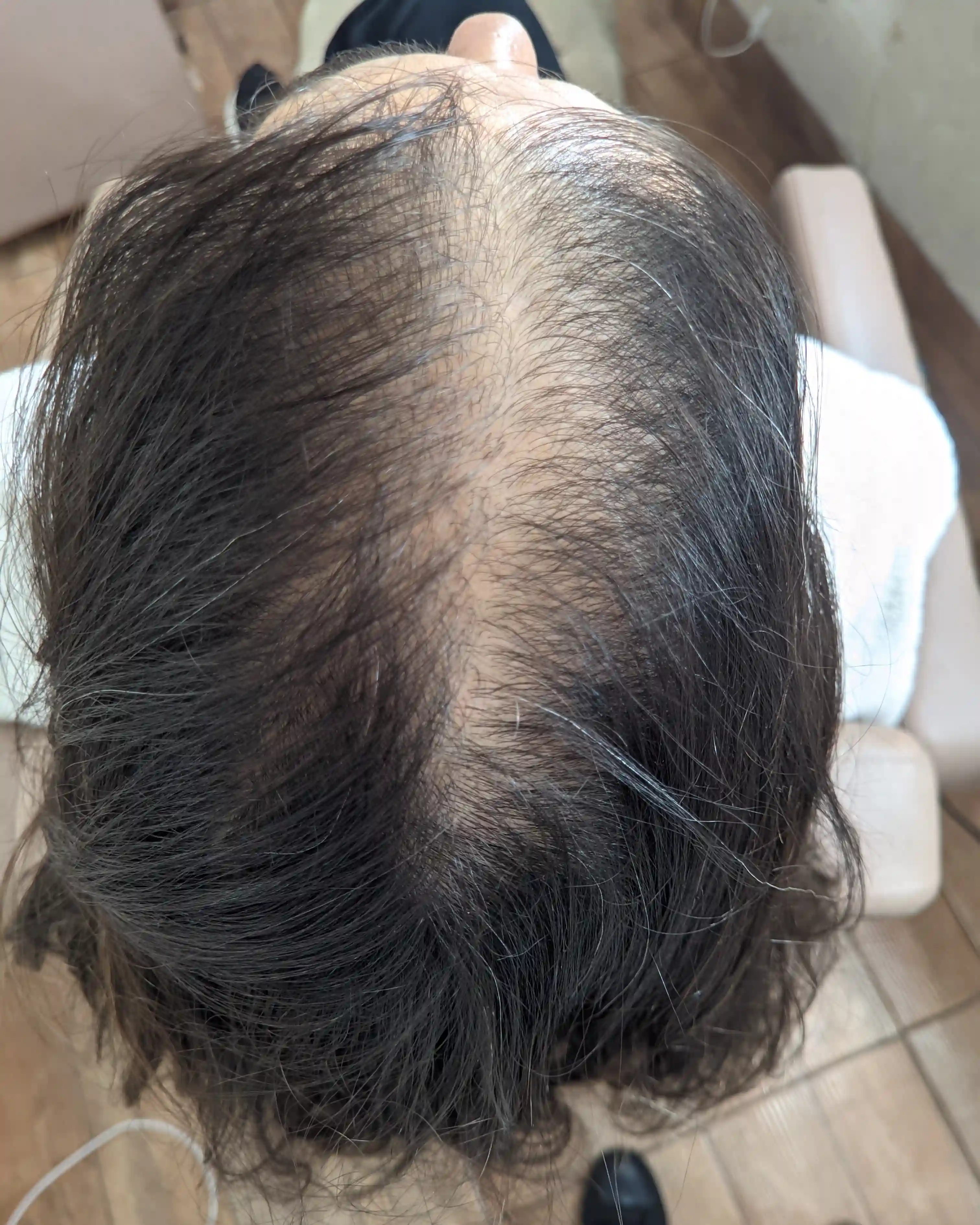 Antes e depois — tratamento de queda capilar em 5 Sessões — Rapha Beauty Tatuapé (Depois)